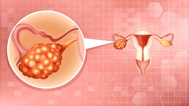 Animated picture of an ovarian tumor