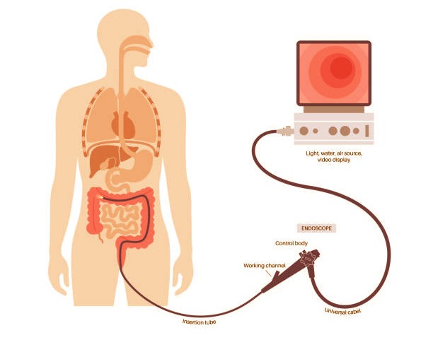 A drawing of what it represents colonoscopy