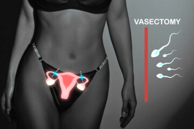 Woman body and illustration vasectomy